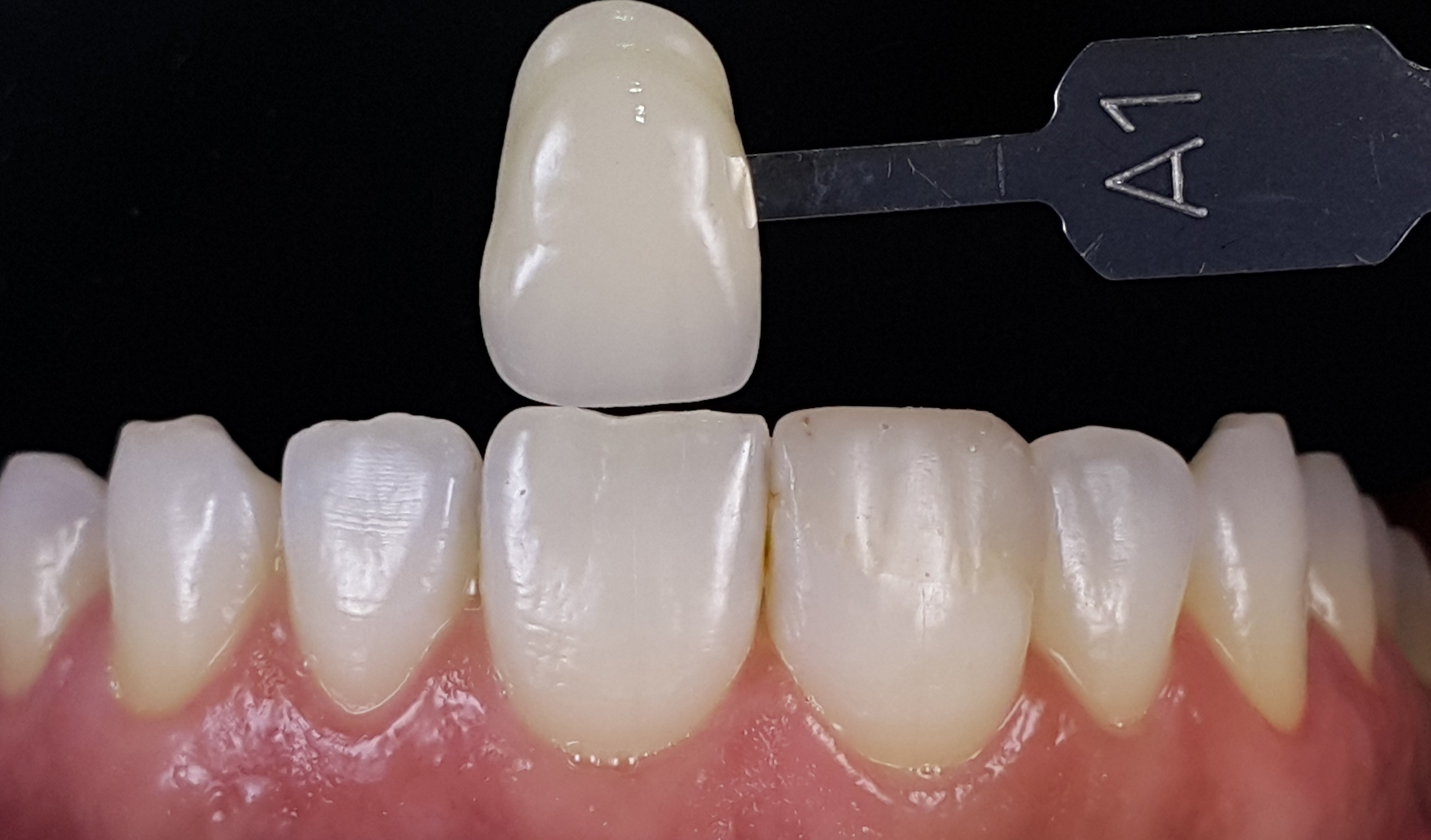How To Master Dental Photography Using Before & After Shots Optident